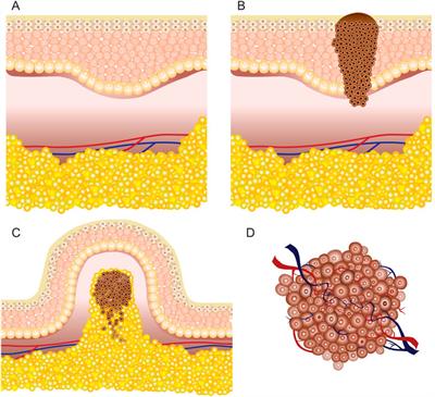 Invasive and non-invasive electrodes for successful drug and gene delivery in electroporation-based treatments